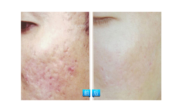 果酸煥膚多少錢？