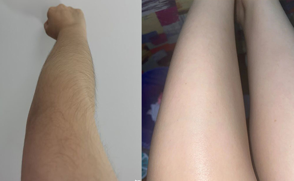 【術(shù)前必看】激光手臂脫毛六大注意事項!