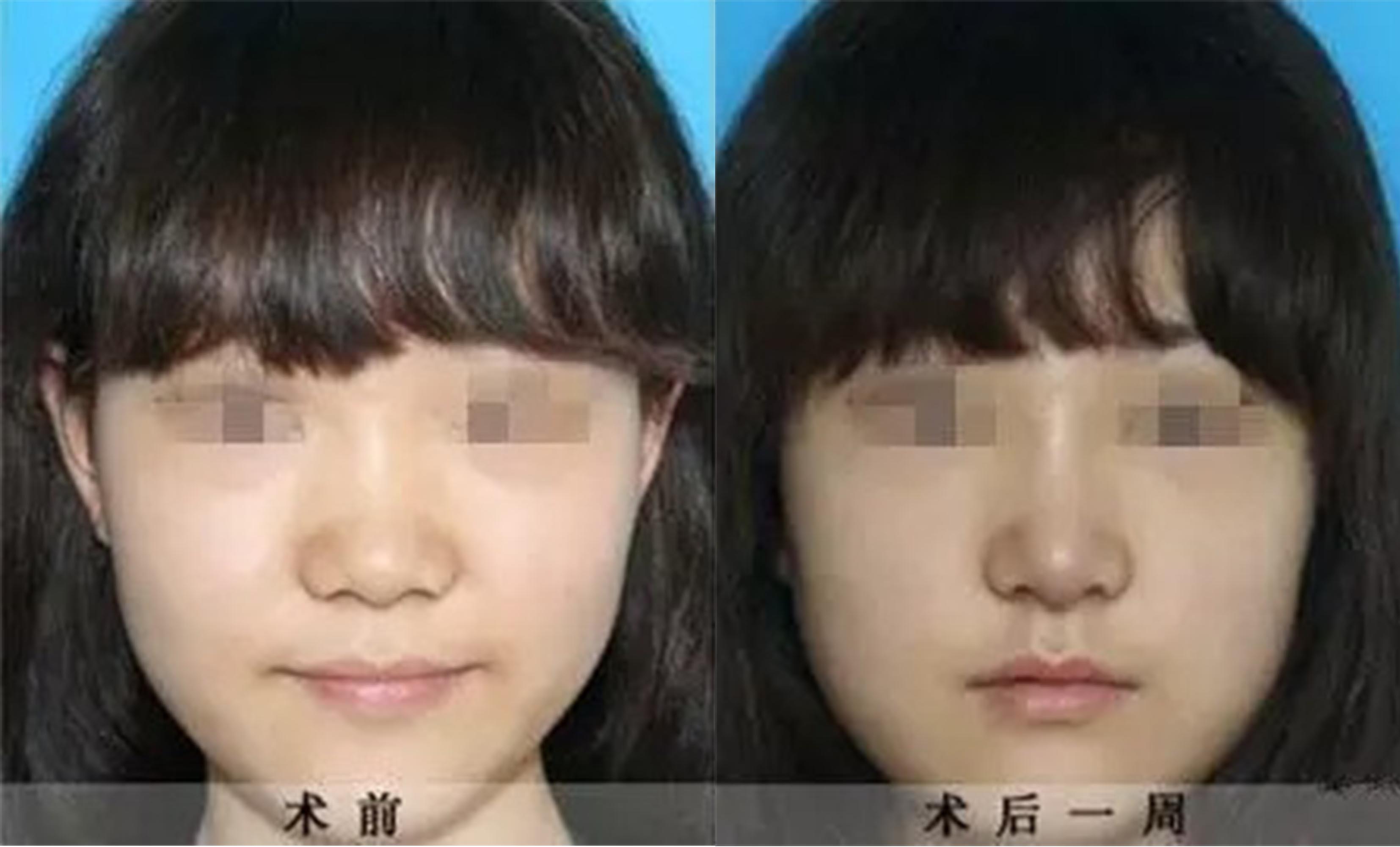 鼻頭、鼻翼縮小