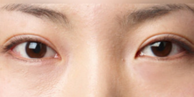 玻尿酸豐臥蠶術(shù)前