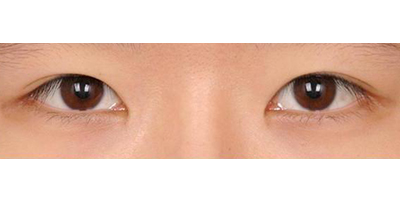 埋線雙眼皮術(shù)前