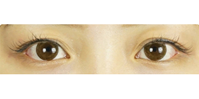 切開雙眼皮術(shù)前