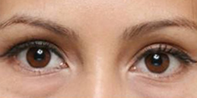 內切祛眼袋術前