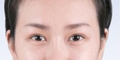 上眼瞼去脂術(shù)后