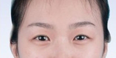 上眼瞼去脂術(shù)前