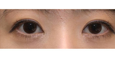 開(kāi)內(nèi)眼角術(shù)后