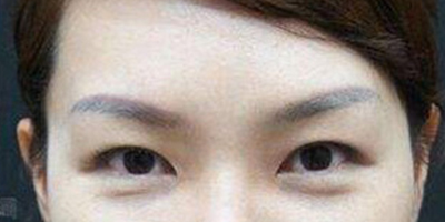 激光祛眼袋術后