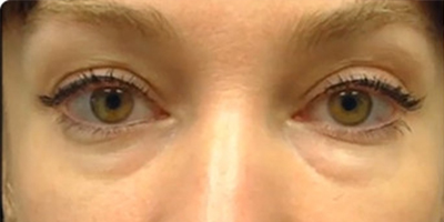 熊貓針去黑眼圈術前