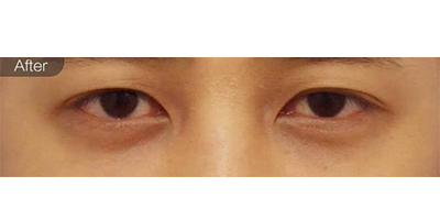 膠原蛋白去黑眼圈術(shù)后