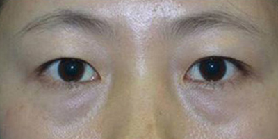 眶隔脂肪釋放術(shù)前