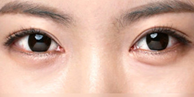 玻尿酸豐臥蠶術(shù)后