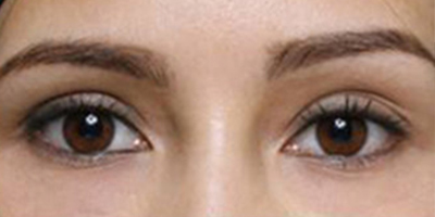 內切祛眼袋術后