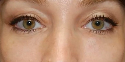 熊貓針去黑眼圈術后