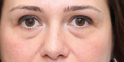 埋線祛眼袋術(shù)前