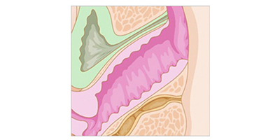 激光緊縮陰道術(shù)前