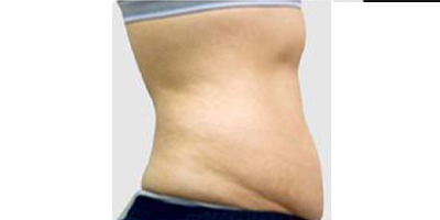 腹壁成形術(shù)術(shù)前