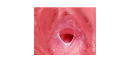 處女膜修復(fù)術(shù)后