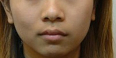 自體脂肪豐面頰術(shù)前