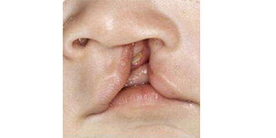 唇腭裂手術術前