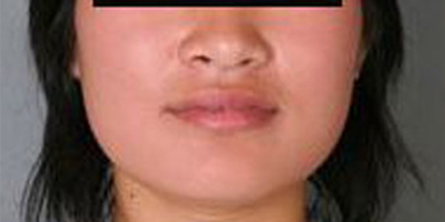取頰脂墊瘦臉術(shù)前