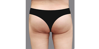 射頻溶脂瘦臀部術(shù)后