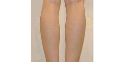 射頻溶脂瘦小腿術(shù)前
