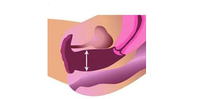 私密超聲提升術前