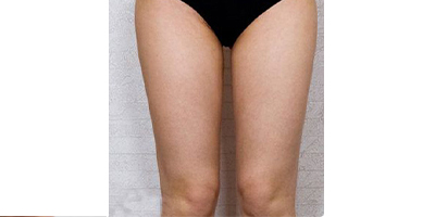 動(dòng)氧瘦大腿術(shù)后