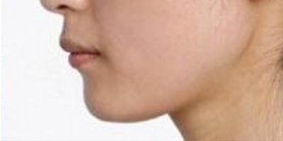 玻尿酸墊下巴術(shù)后