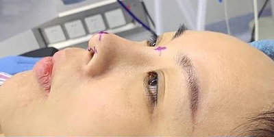 肋軟骨隆鼻術(shù)前