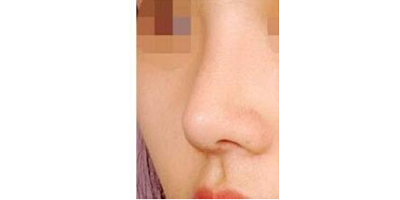 駝峰鼻矯正術(shù)后