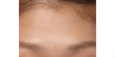 自體脂肪豐額頭術(shù)前