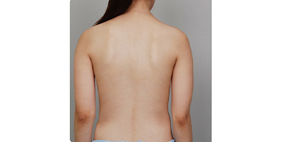 動氧瘦腰部術(shù)前