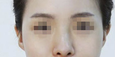 玻尿酸豐太陽穴術(shù)后