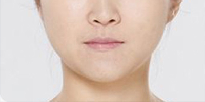 光纖溶脂瘦臉術前