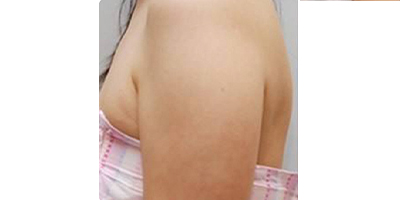 超聲溶脂瘦手臂術(shù)前