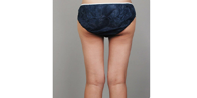 隔空溶脂瘦臀部術(shù)后