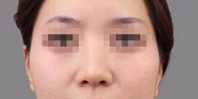 顴骨內(nèi)推術(shù)前