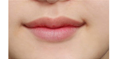 玻尿酸豐唇珠術(shù)后