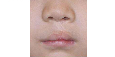 唇腭裂手術術后