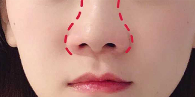 注射縮鼻頭術(shù)前