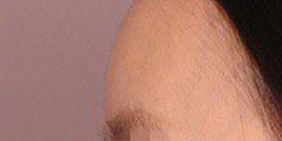 假體豐額頭術(shù)后