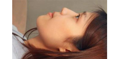 埋線隆鼻術(shù)前