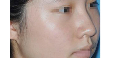 玻尿酸豐鼻基底術(shù)前