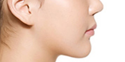 下巴截骨術術后