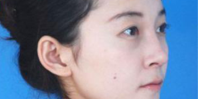 曼特波隆鼻術(shù)后