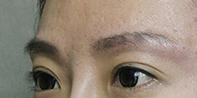 玻尿酸豐眉弓術(shù)后