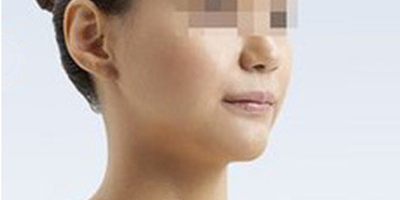 下顎前突/地包天術(shù)后