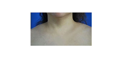 聚能震波吸脂術前