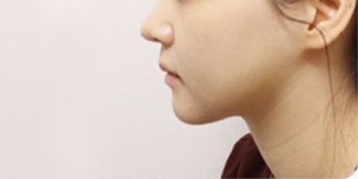 激光溶脂瘦臉術(shù)后